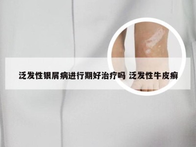 泛发性银屑病进行期好治疗吗 泛发性牛皮癣