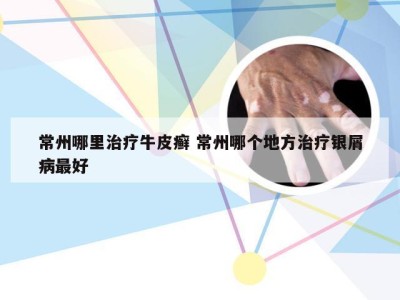 常州哪里治疗牛皮癣 常州哪个地方治疗银屑病最好