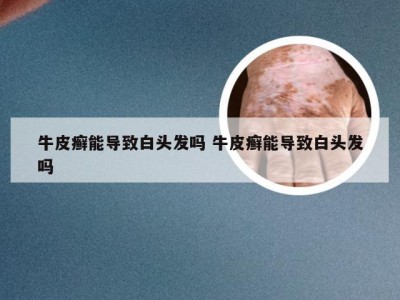 牛皮癣能导致白头发吗 牛皮癣能导致白头发吗