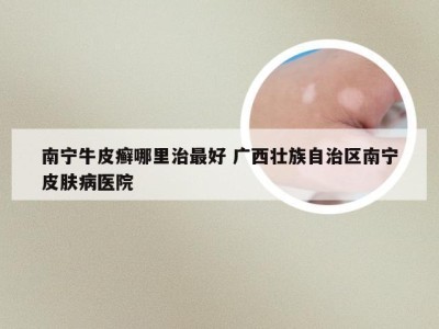 南宁牛皮癣哪里治最好 广西壮族自治区南宁皮肤病医院