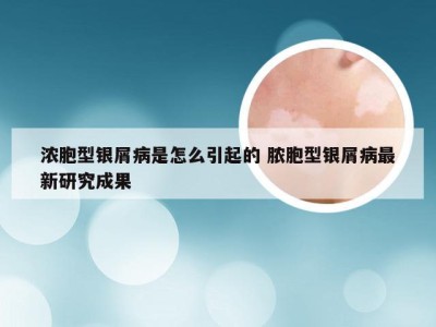 浓胞型银屑病是怎么引起的 脓胞型银屑病最新研究成果