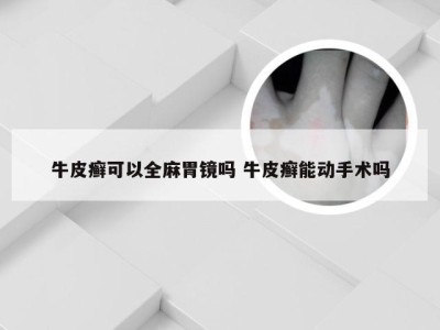 牛皮癣可以全麻胃镜吗 牛皮癣能动手术吗