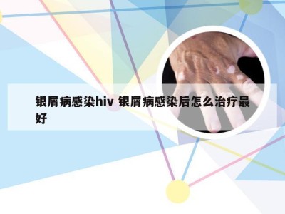 银屑病感染hiv 银屑病感染后怎么治疗最好