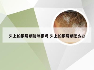 头上的银屑病能除根吗 头上的银屑病怎么办