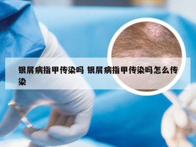 银屑病指甲传染吗 银屑病指甲传染吗怎么传染