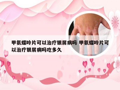 甲氨蝶呤片可以治疗银屑病吗 甲氨蝶呤片可以治疗银屑病吗吃多久