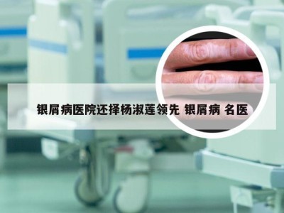 银屑病医院还择杨淑莲领先 银屑病 名医