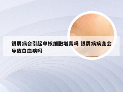 银屑病会引起单核细胞增高吗 银屑病病变会导致白血病吗
