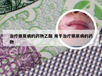 治疗银屑病的药物乙酸 用于治疗银屑病的药物