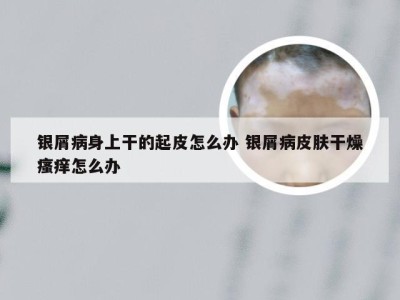 银屑病身上干的起皮怎么办 银屑病皮肤干燥瘙痒怎么办