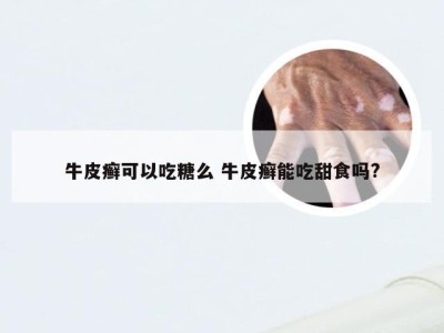 牛皮癣可以吃糖么 牛皮癣能吃甜食吗?