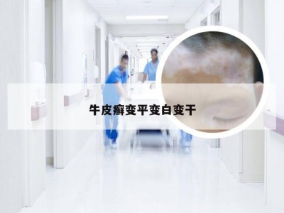 牛皮癣变平变白变干