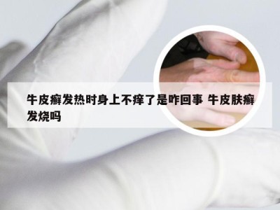 牛皮癣发热时身上不痒了是咋回事 牛皮肤癣发烧吗