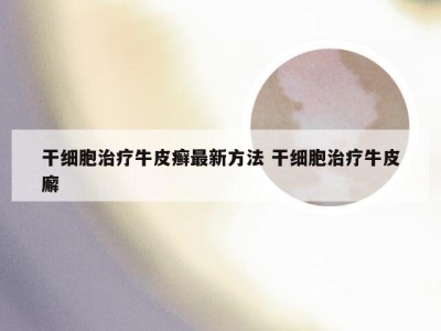 干细胞治疗牛皮癣最新方法 干细胞治疗牛皮廨