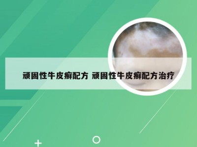 顽固性牛皮癣配方 顽固性牛皮癣配方治疗