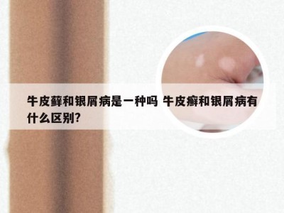 牛皮藓和银屑病是一种吗 牛皮癣和银屑病有什么区别?