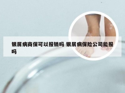 银屑病商保可以报销吗 银屑病保险公司能报吗