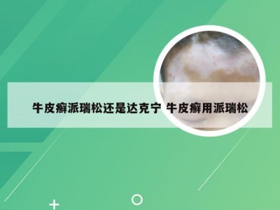 牛皮癣派瑞松还是达克宁 牛皮癣用派瑞松