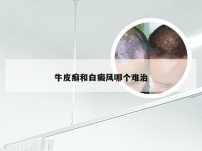 牛皮癣和白癜风哪个难治