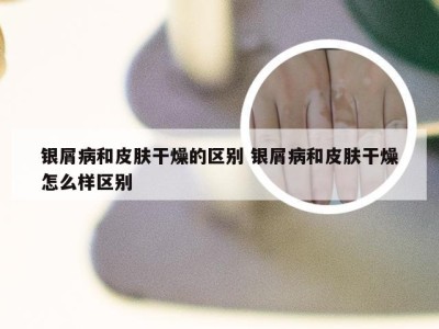 银屑病和皮肤干燥的区别 银屑病和皮肤干燥怎么样区别