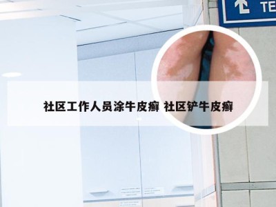 社区工作人员涂牛皮癣 社区铲牛皮癣