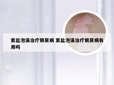 紫盐泡澡治疗银屑病 紫盐泡澡治疗银屑病有用吗
