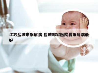 江苏盐城市银屑病 盐城哪家医院看银屑病最好