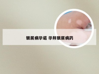 银屑病华诺 华邦银屑病药