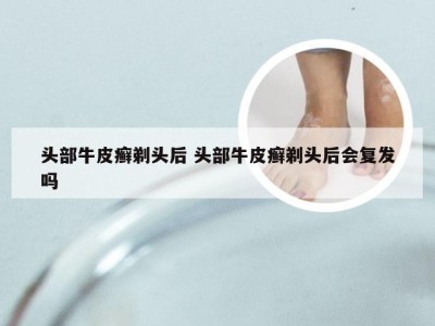头部牛皮癣剃头后 头部牛皮癣剃头后会复发吗