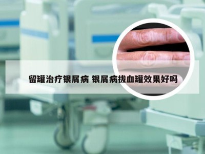 留罐治疗银屑病 银屑病拔血罐效果好吗
