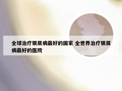 全球治疗银屑病最好的国家 全世界治疗银屑病最好的医院