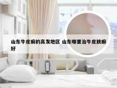 山东牛皮癣的高发地区 山东哪里治牛皮肤癣好