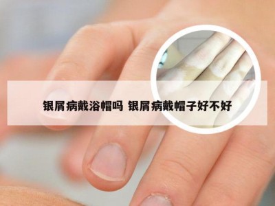 银屑病戴浴帽吗 银屑病戴帽子好不好