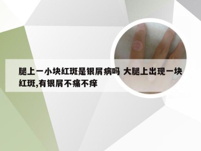 腿上一小块红斑是银屑病吗 大腿上出现一块红斑,有银屑不痛不痒