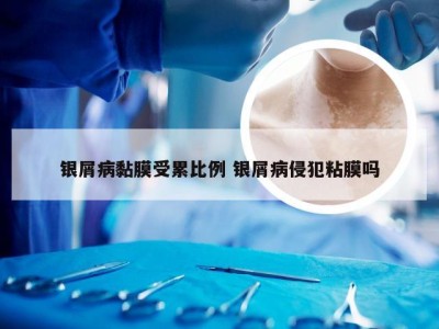银屑病黏膜受累比例 银屑病侵犯粘膜吗