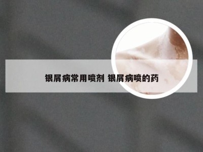 银屑病常用喷剂 银屑病喷的药