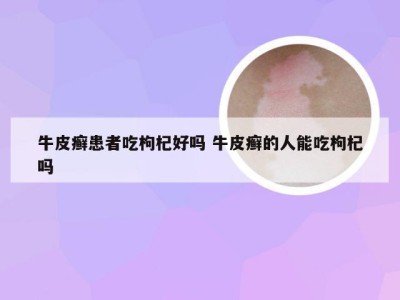 牛皮癣患者吃枸杞好吗 牛皮癣的人能吃枸杞吗