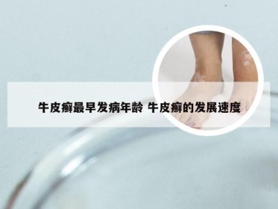 牛皮癣最早发病年龄 牛皮癣的发展速度