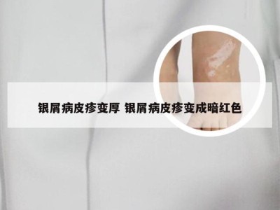 银屑病皮疹变厚 银屑病皮疹变成暗红色