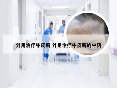 外用治疗牛皮癣 外用治疗牛皮癣的中药