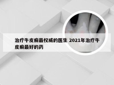 治疗牛皮癣最权威的医生 2021年治疗牛皮癣最好的药