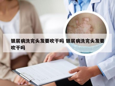 银屑病洗完头发要吹干吗 银屑病洗完头发要吹干吗