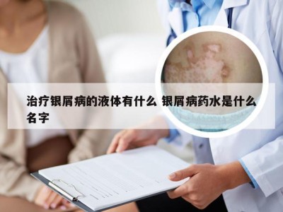 治疗银屑病的液体有什么 银屑病药水是什么名字