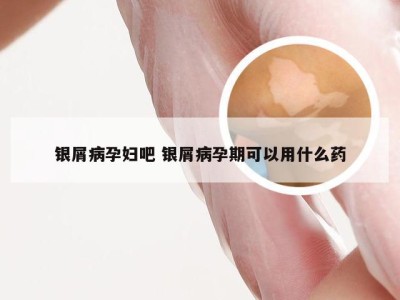 银屑病孕妇吧 银屑病孕期可以用什么药