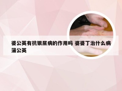 婆公英有抗银屑病的作用吗 婆婆丁治什么病蒲公英