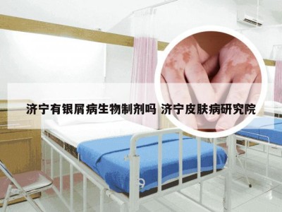 济宁有银屑病生物制剂吗 济宁皮肤病研究院