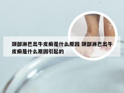 颈部淋巴出牛皮癣是什么原因 颈部淋巴出牛皮癣是什么原因引起的