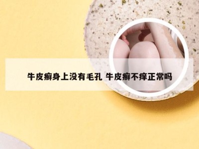 牛皮癣身上没有毛孔 牛皮癣不痒正常吗