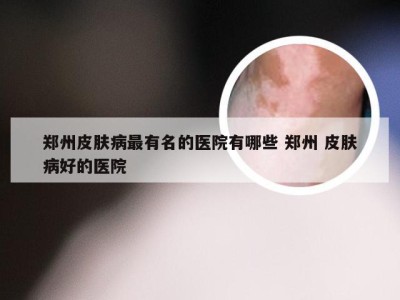 郑州皮肤病最有名的医院有哪些 郑州 皮肤病好的医院