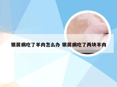 银屑病吃了羊肉怎么办 银屑病吃了两块羊肉